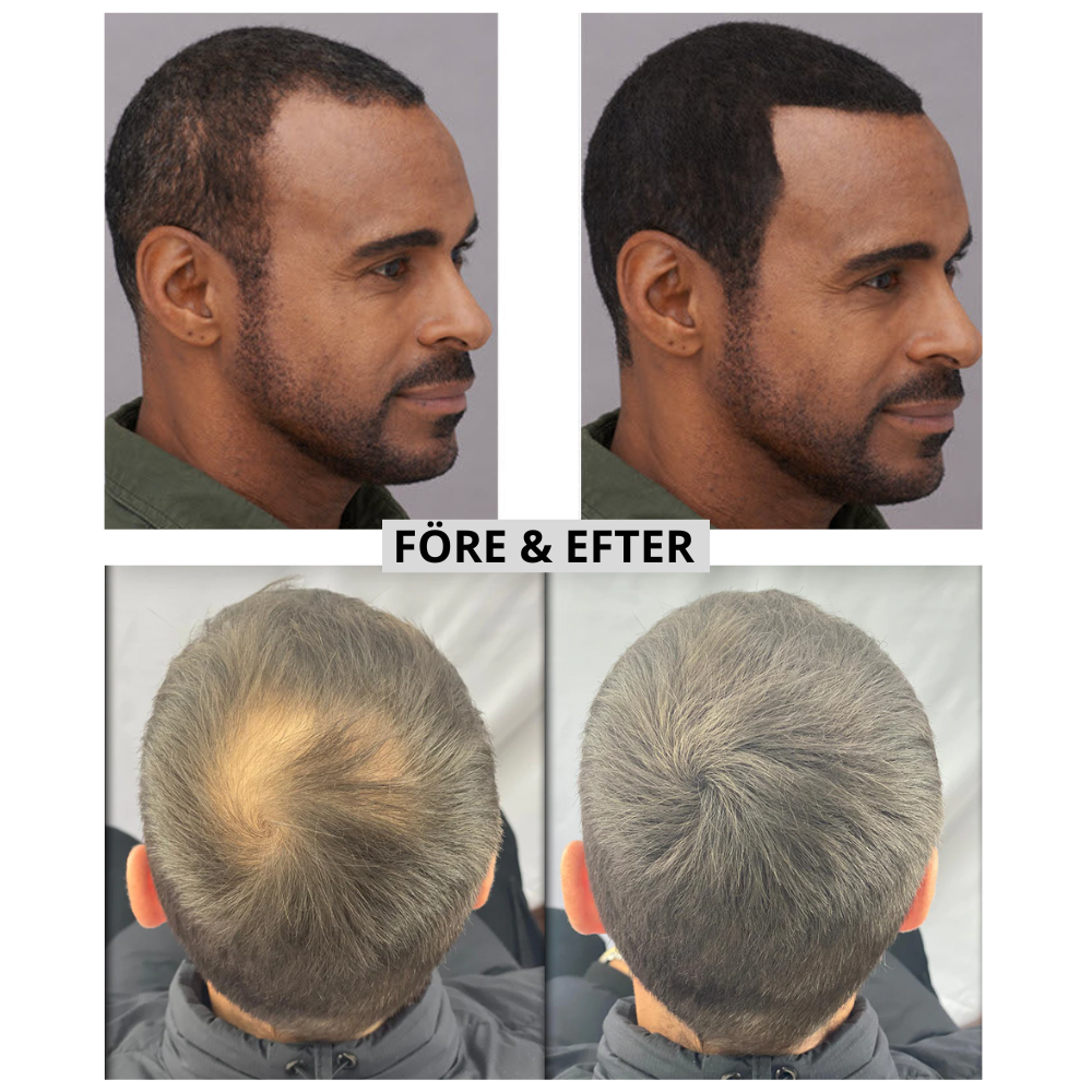 BHFM`s Hårpuder - Få tillbaka självförtroendet och håret utan behandlingar